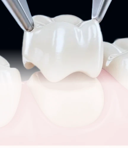 3D render of a ceramic dental crown used for tooth restoration.
