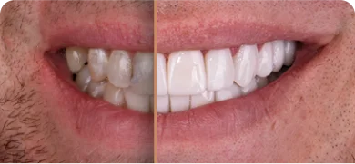 Smile transformation with same-day crown placement by top San Diego dentist
