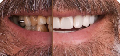 Before and after photo of dental veneers treatment at Dental Expressions in San Diego