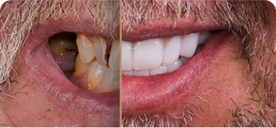 Before and after comparison of cosmetic dental work using CEREC technology