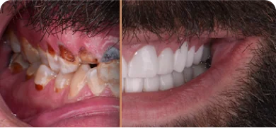 Full dental makeover results from Dental Expressions in Navajo, San Diego