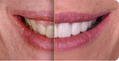 Emax porcelain veneers before and after by trusted dentist near San Carlos and Del Cerr