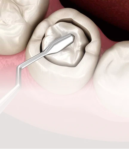 3D render of a dentist filling a tooth cavity.