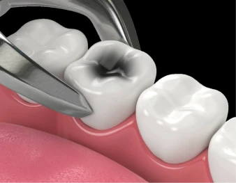 3D render showing the placement of a dental inlay or onlay to repair a damaged molar.