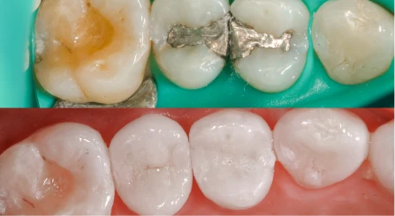 Side-by-side comparison of old amalgam fillings and new tooth-colored composite fillings.