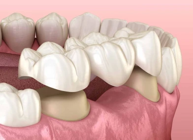 3-unit dental bridge package for tooth replacement.