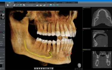 Panoramic dental X-ray showing full mouth structure.