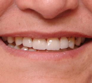 Enhanced smile after cosmetic dental procedures.