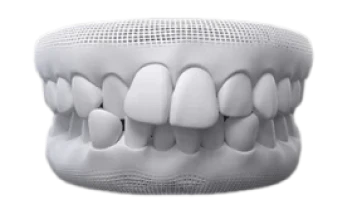 3D dental model showing crowded teeth that can be straightened using clear aligners.