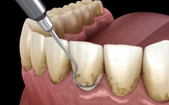 Detailed 3D model of a teeth cleaning procedure highlighting how San Diego dentists use advanced tools to remove buildup.