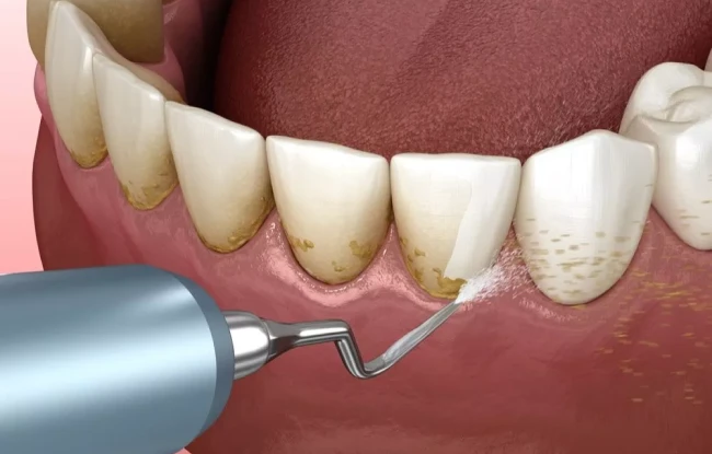 3D dental cleaning illustration showing plaque and tartar removal, teeth cleaning treatment available at My Smile Clinic in San Diego.
