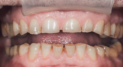 Comprehensive dental cleaning performed by skilled dentists at My Smile Dental Clinic in San Diego.