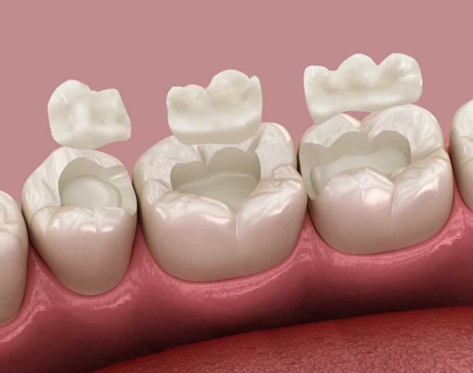 Dental Inlays and Onlays amalgam filling image, demonstrating cavity repair and tooth restoration in San Diego, California.