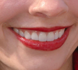Post-treatment smile with noticeable dental improvement.