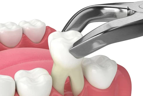 Standard dental extraction procedure for damaged teeth, performed by licensed dentists in San Diego.