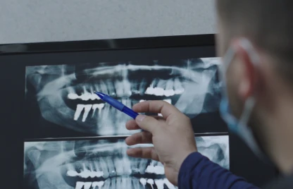 Dentist reviewing dental X-rays to diagnose the need for root canal treatment.