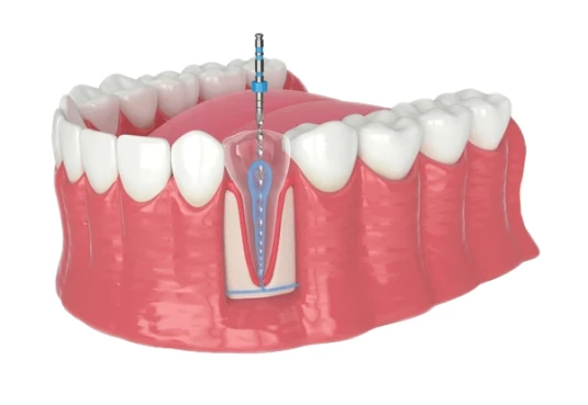 3D illustration showing a root canal treatment removing infected pulp from inside the tooth.