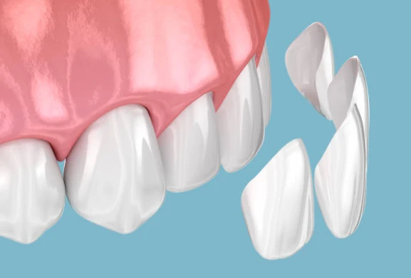 Smile makeover with Lumineers ultra-thin veneers for natural-looking cosmetic enhancement. Minimally invasive smile design in San Diego.
