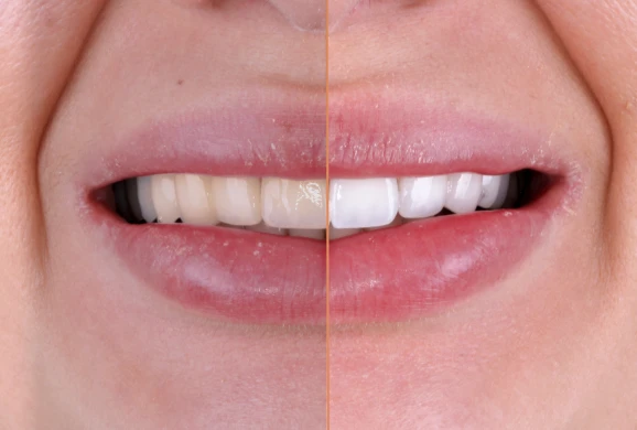 Smile makeover featuring professional teeth whitening for brighter, whiter teeth. Cosmetic enhancement performed in San Diego.