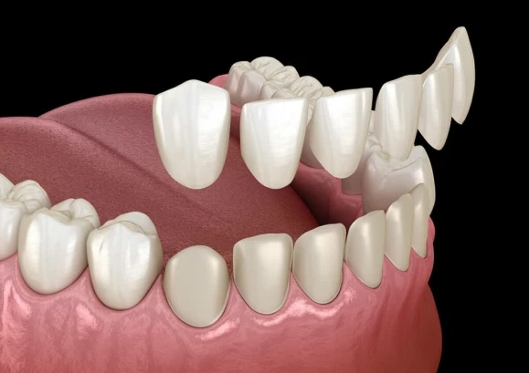 Smile makeover with dental veneers for flawless tooth shape and color correction treatments in San Diego.