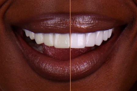 Before and after teeth whitening comparison from My Smile Clinic San Diego, showcasing the visible transformation and professional results.