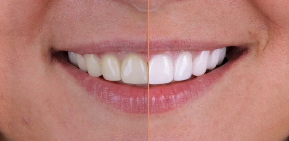 Before and after teeth whitening results in San Diego showcasing a dramatic boost in brightness. Expert cosmetic care at My Smile Clinic.