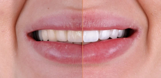 Before and after teeth whitening results in San Diego showcasing a dramatic boost in brightness. Expert cosmetic care at My Smile Clinic.