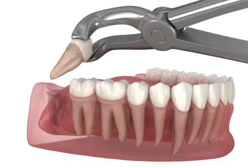 Wisdom tooth extraction illustration showing surgical removal of impacted molars. Oral surgery services offered at My Smile in San Diego.
