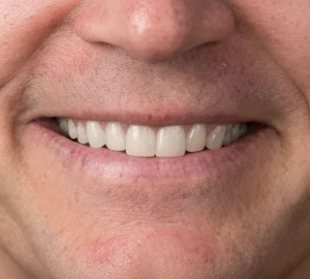 Natural-looking smile achieved through zirconia veneers restoration.